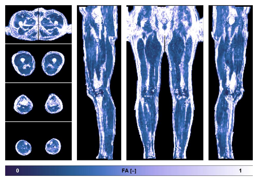 IVIM corrected whole leg muscle fractional anisotropy obtained from diffusion tensor imaging.