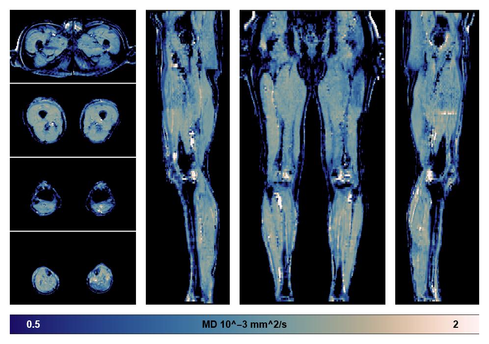 IVIM corrected whole leg muscle mean diffusivity obtained from diffusion tensor imaging.