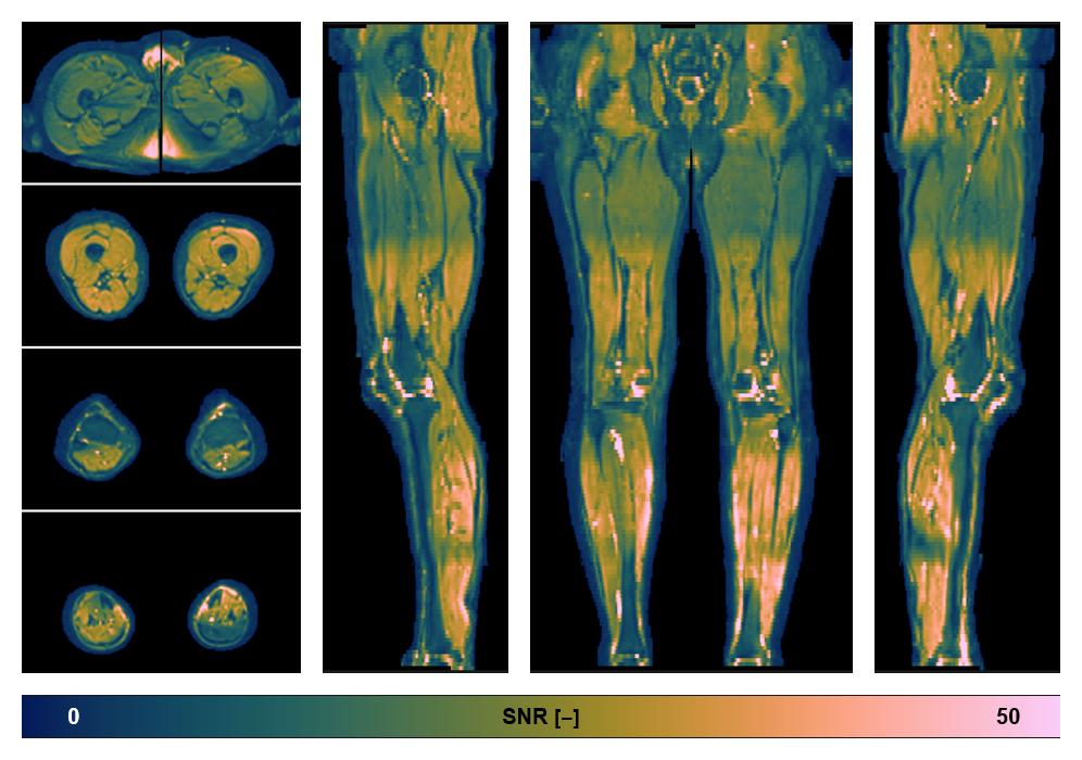 SNR distribution of the unweighted diffusion data.
