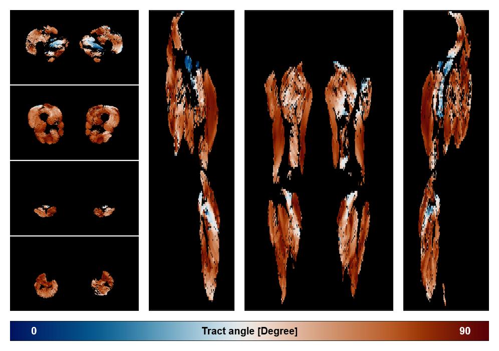 Muscle fiber tract angle map based on whole leg DTI based fiber tractography.