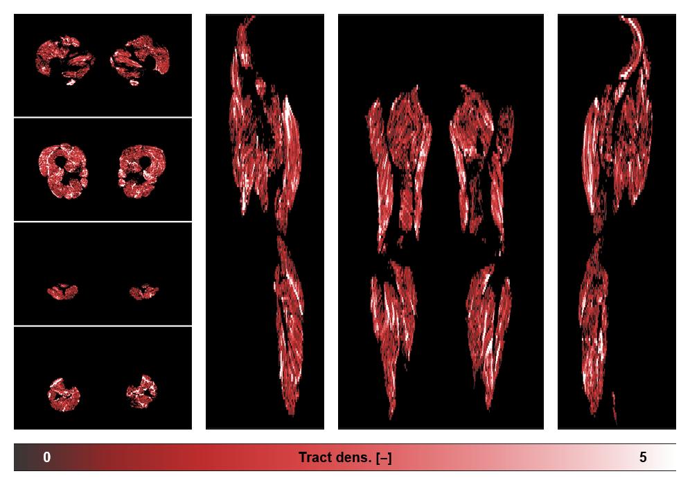 Muscle fiber tract density map based on whole leg DTI based fiber tractography.