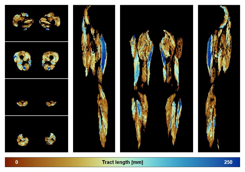 Muscle fiber tract length map based on whole leg DTI based fiber tractography.