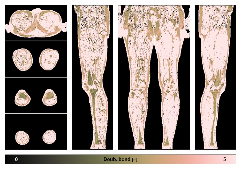 Number of double bonds in subcutanious fat.