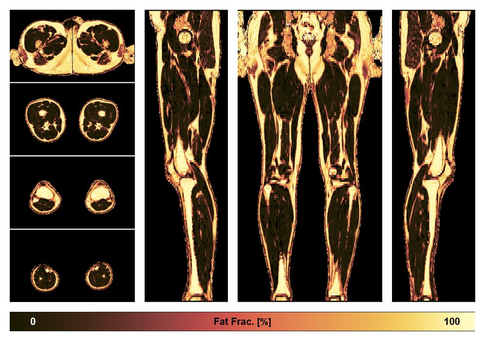 The fat fraction of the lower extremity obtained from the dixon reconstruction for muscle water fat quantification.