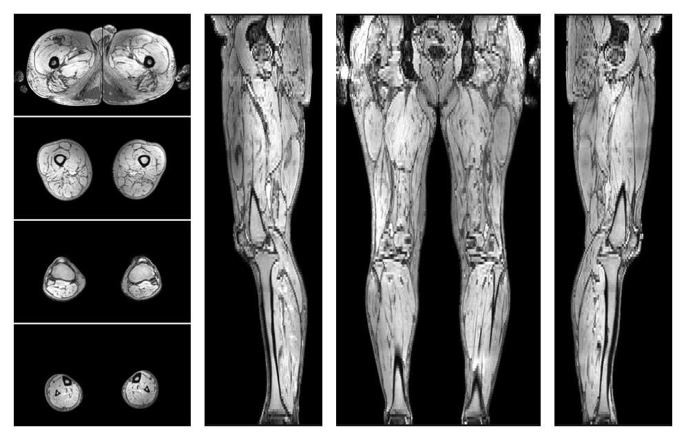 The out-phase image of the dixon reconstruction for water fat quantification.