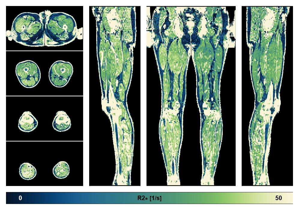 The R2 star relaxation time of the lower extremity obtained from the dixon reconstruction for muscle water fat quantification.