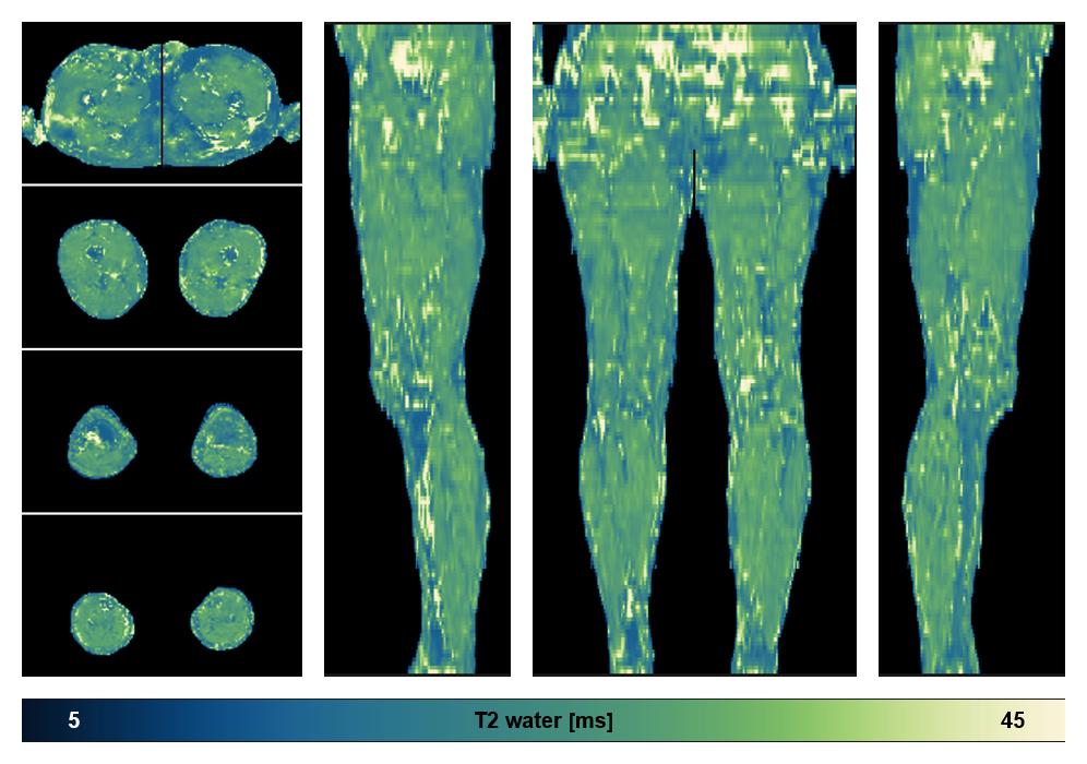 The water only T2 relaxation time of the lower extremity obtained from multi echo spin echo t2 mapping with EPG based reconstruction.