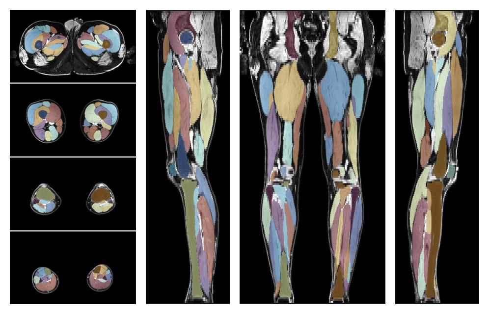 Overlay of automated muscle segmentation labels on dixon water image.