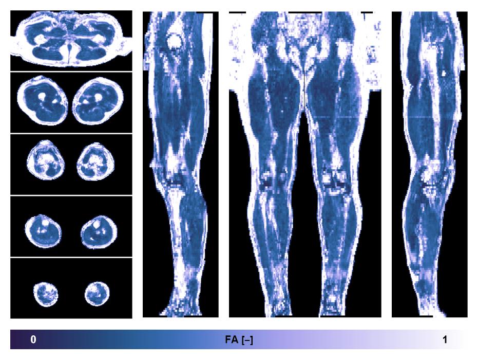 IVIM corrected whole leg muscle fractional anisotropy obtained from diffusion tensor imaging.