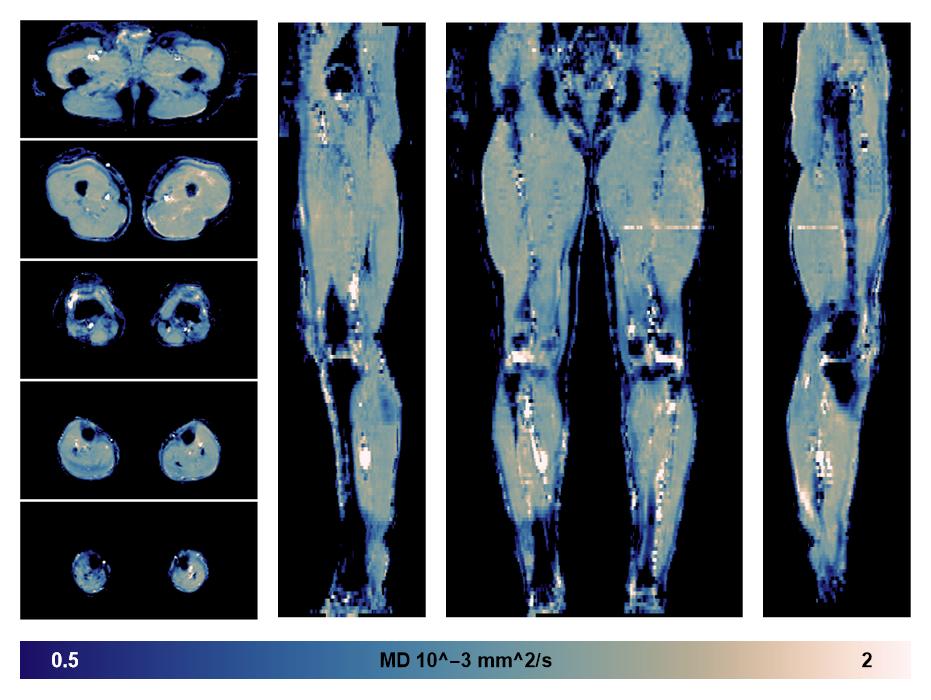 IVIM corrected whole leg muscle mean diffusivity obtained from diffusion tensor imaging.