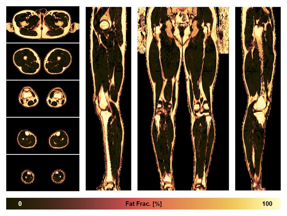 The fat fraction of the lower extremity obtained from the dixon reconstruction for muscle water fat quantification.