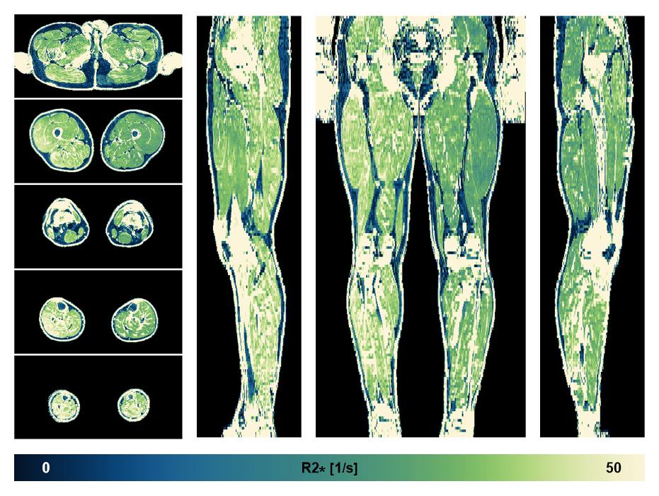 The R2 star relaxation time of the lower extremity obtained from the dixon reconstruction for muscle water fat quantification.