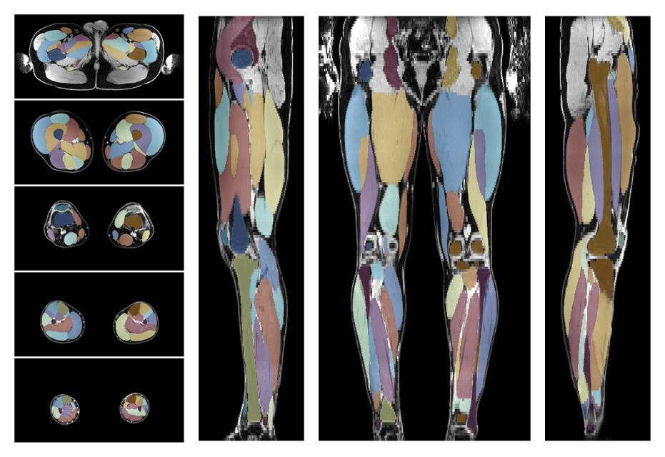 Overlay of automated muscle segmentation labels on dixon water image.