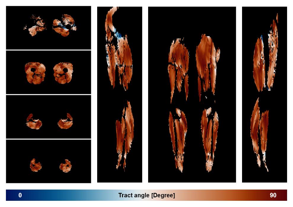 Muscle fiber tract angle map based on whole leg DTI based fiber tractography.