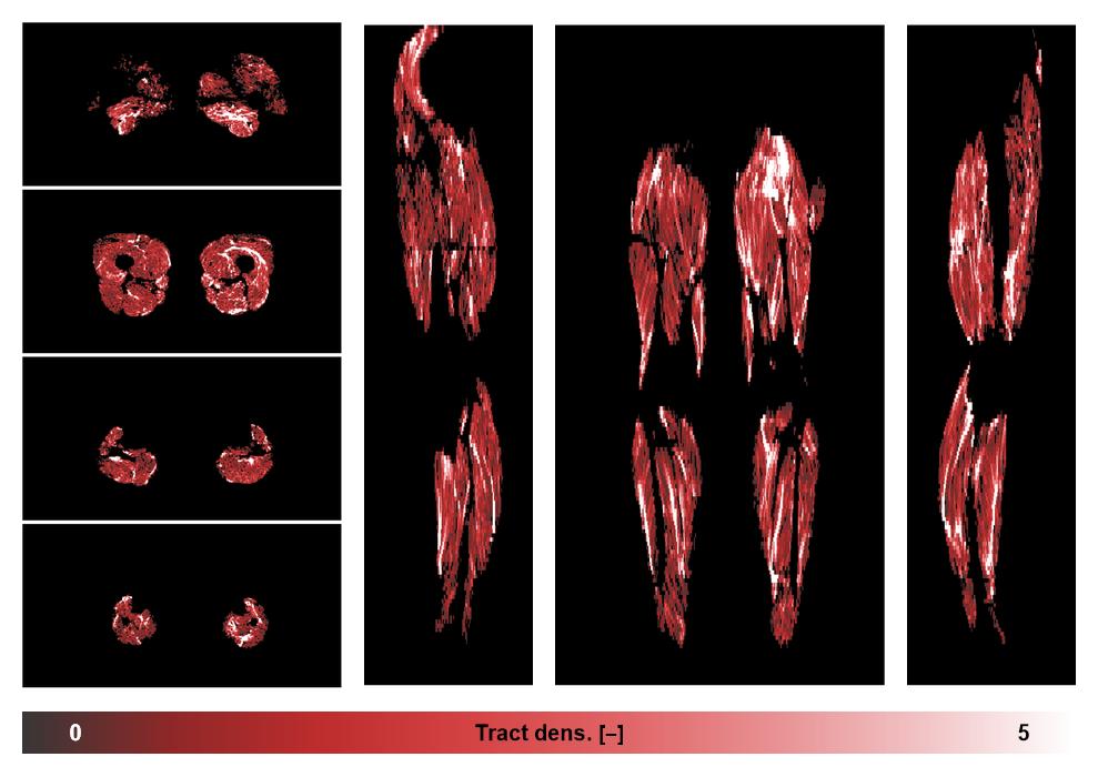 Muscle fiber tract density map based on whole leg DTI based fiber tractography.