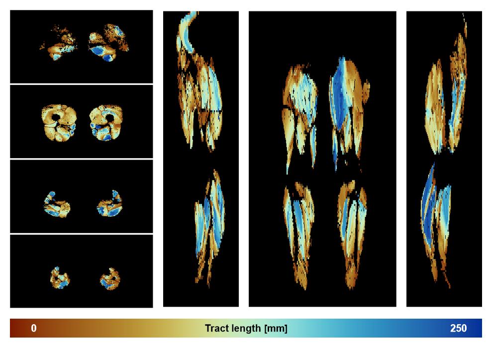Muscle fiber tract length map based on whole leg DTI based fiber tractography.