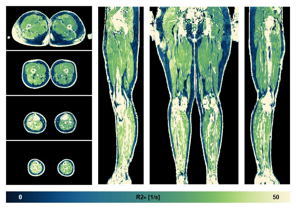 The R2 star relaxation time of the lower extremity obtained from the dixon reconstruction for muscle water fat quantification.