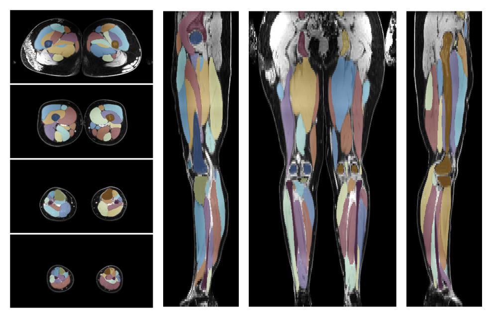 Overlay of automated muscle segmentation labels on dixon water image.