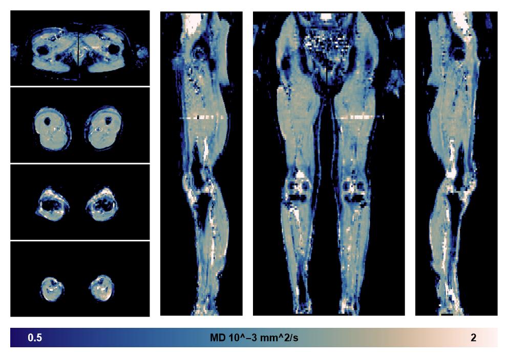 IVIM corrected whole leg muscle mean diffusivity obtained from diffusion tensor imaging.