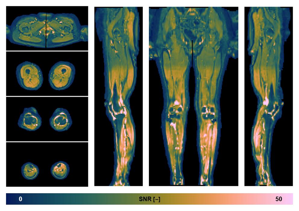 SNR distribution of the unweighted diffusion data.