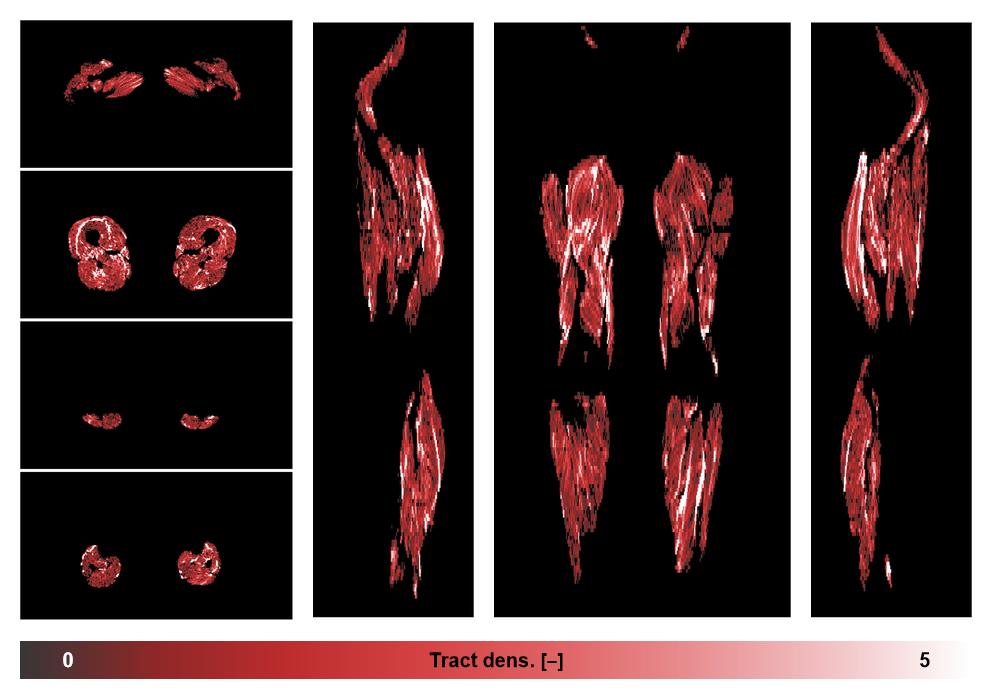 Muscle fiber tract density map based on whole leg DTI based fiber tractography.