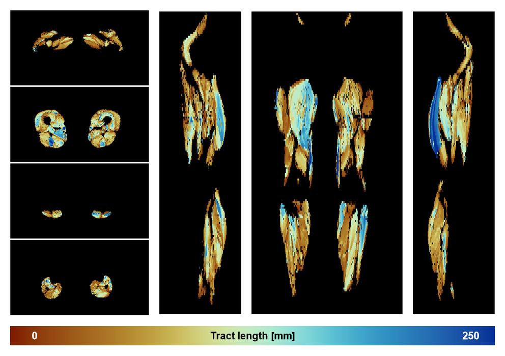 Muscle fiber tract length map based on whole leg DTI based fiber tractography.
