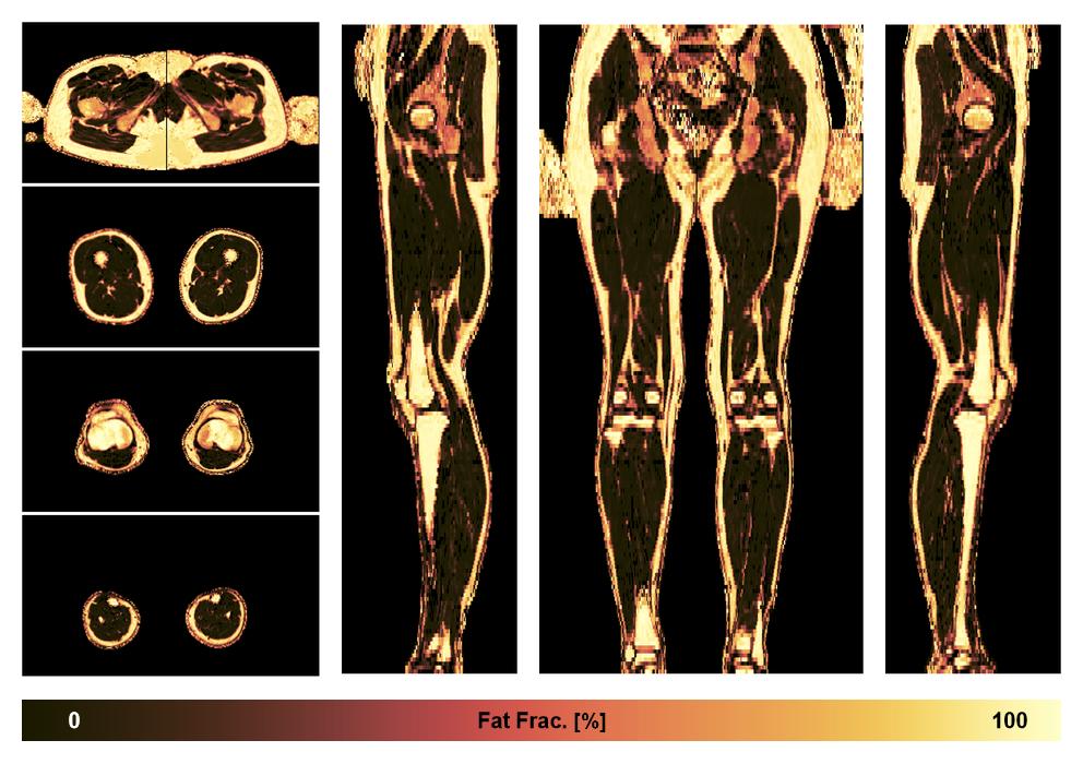 The fat fraction of the lower extremity obtained from the dixon reconstruction for muscle water fat quantification.