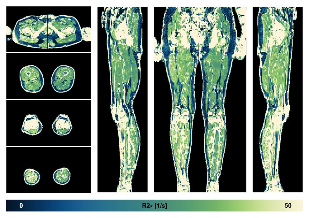 The R2 star relaxation time of the lower extremity obtained from the dixon reconstruction for muscle water fat quantification.