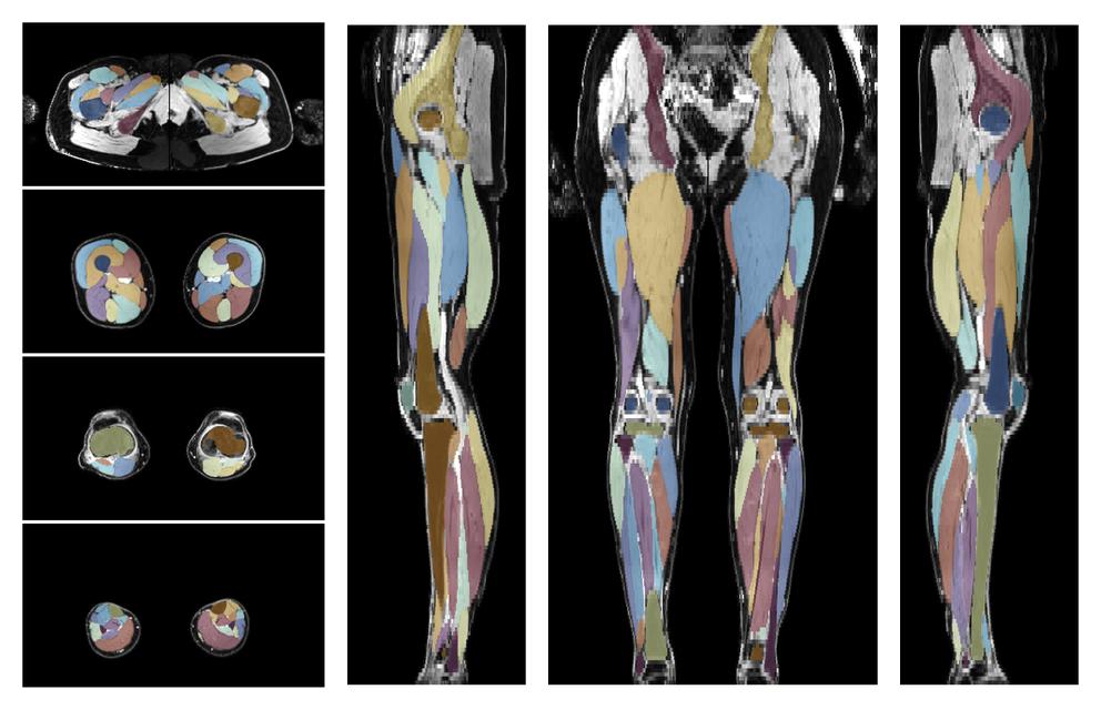 Overlay of automated muscle segmentation labels on dixon water image.