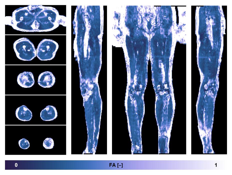 IVIM corrected whole leg muscle fractional anisotropy obtained from diffusion tensor imaging.