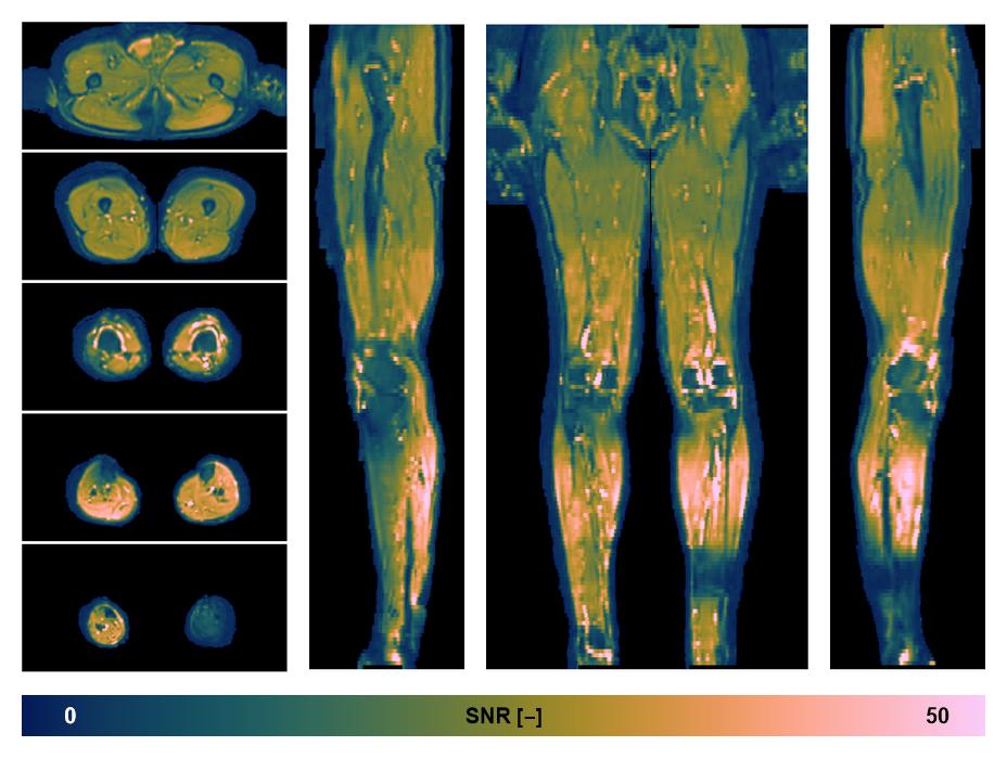 SNR distribution of the unweighted diffusion data.