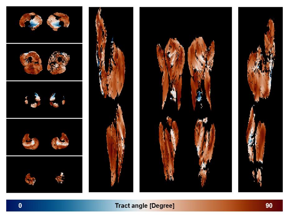 Muscle fiber tract angle map based on whole leg DTI based fiber tractography.