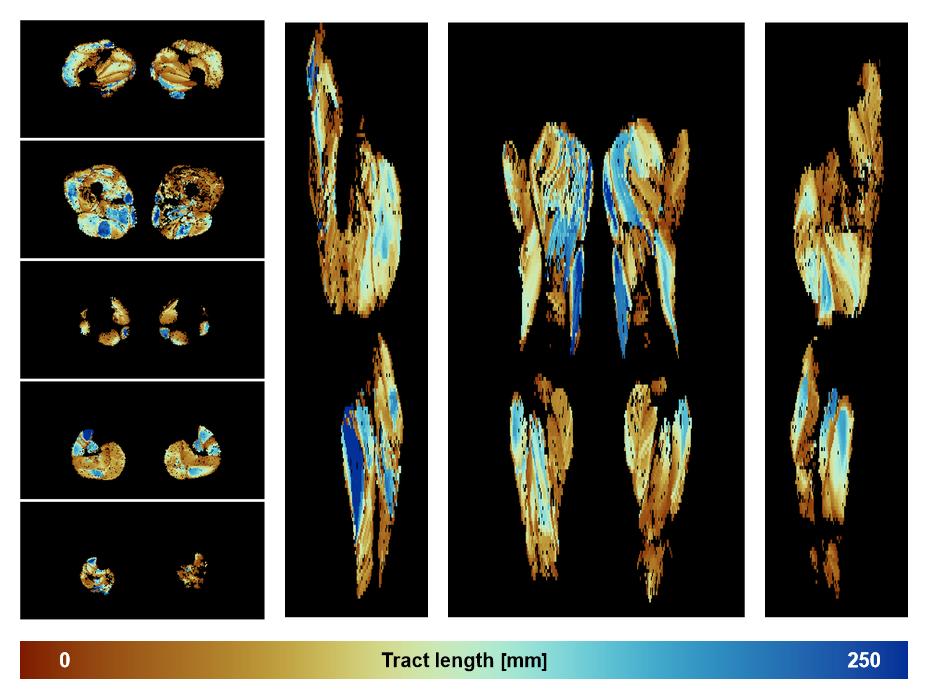 Muscle fiber tract length map based on whole leg DTI based fiber tractography.