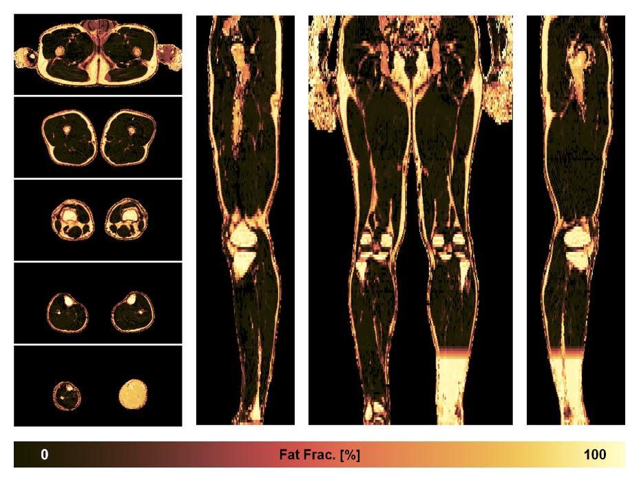 The fat fraction of the lower extremity obtained from the dixon reconstruction for muscle water fat quantification.