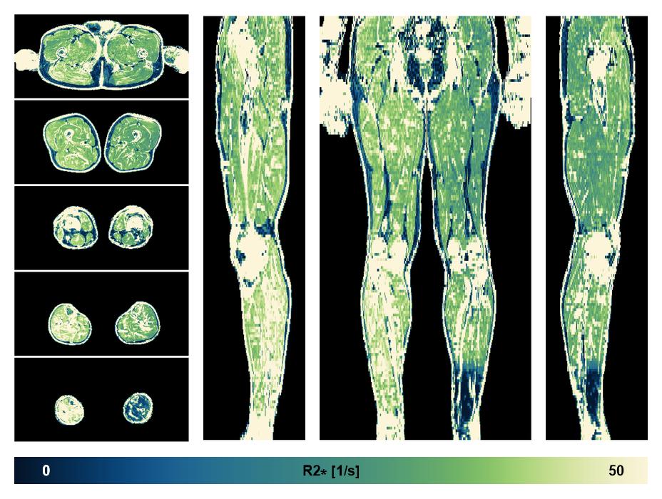 The R2 star relaxation time of the lower extremity obtained from the dixon reconstruction for muscle water fat quantification.