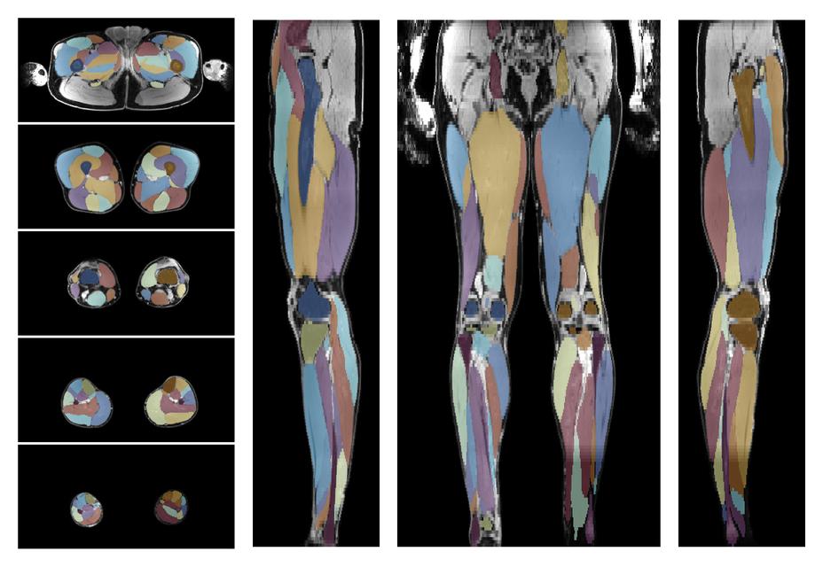 Overlay of automated muscle segmentation labels on dixon water image.
