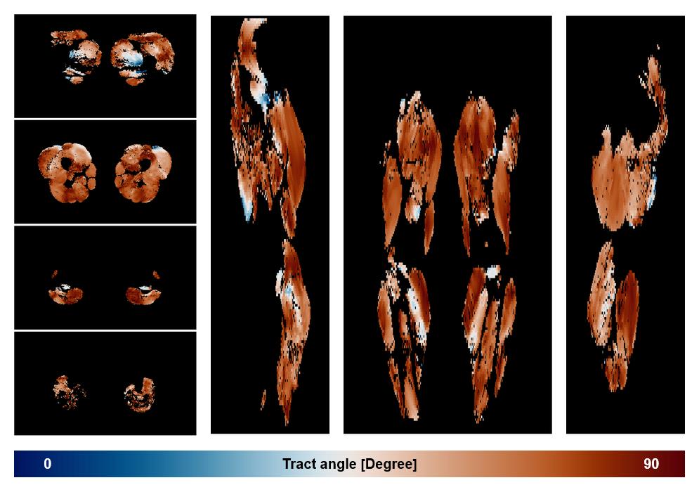 Muscle fiber tract angle map based on whole leg DTI based fiber tractography.