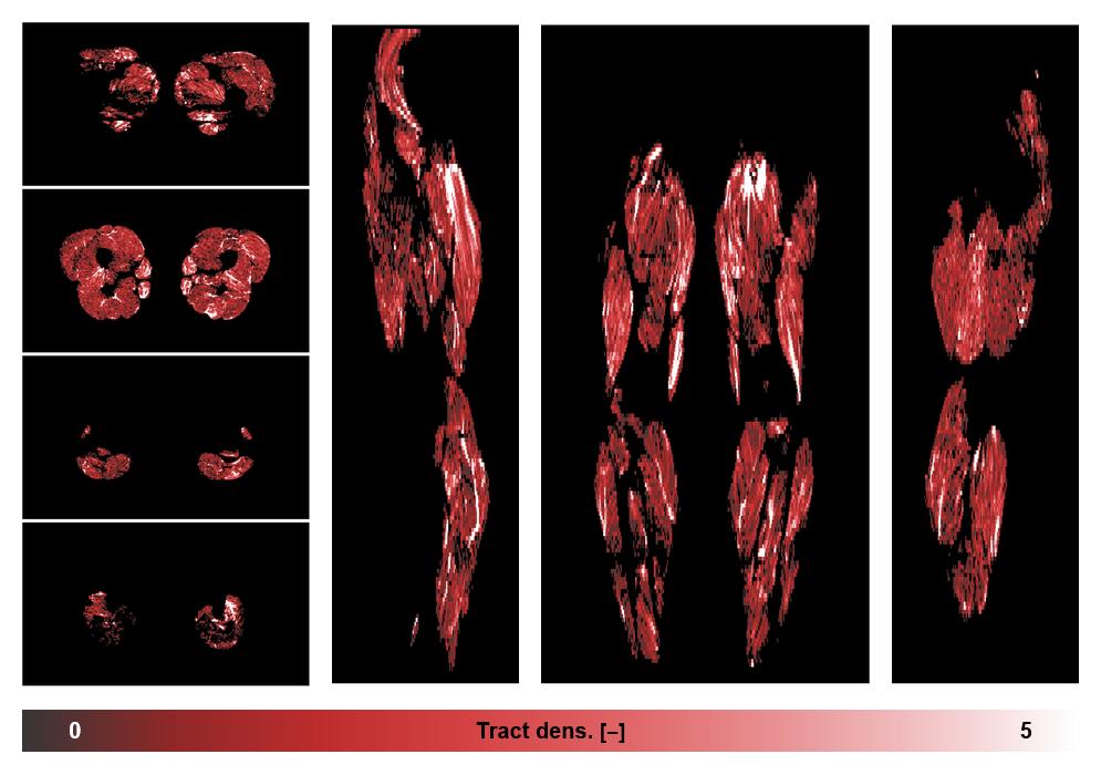 Muscle fiber tract density map based on whole leg DTI based fiber tractography.