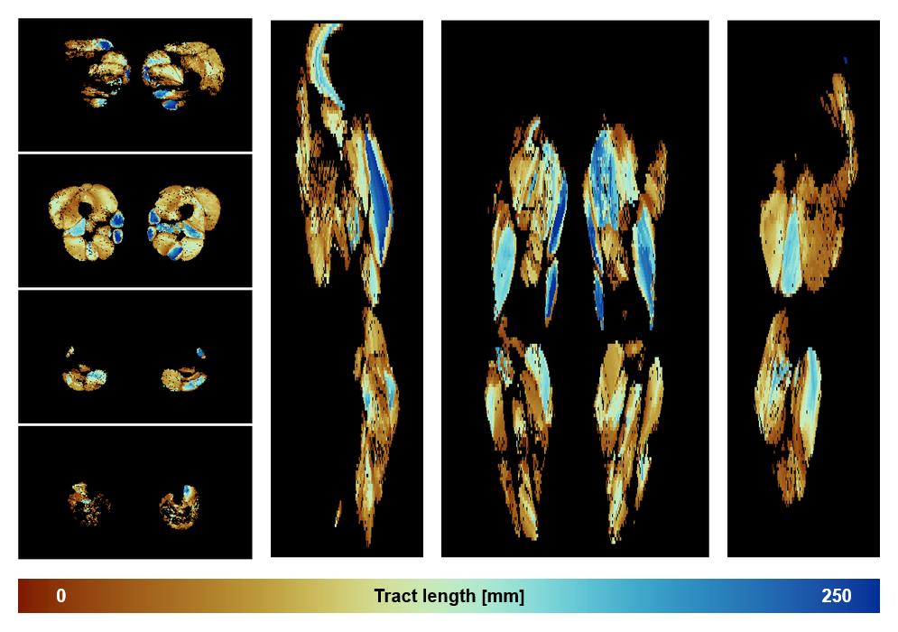 Muscle fiber tract length map based on whole leg DTI based fiber tractography.