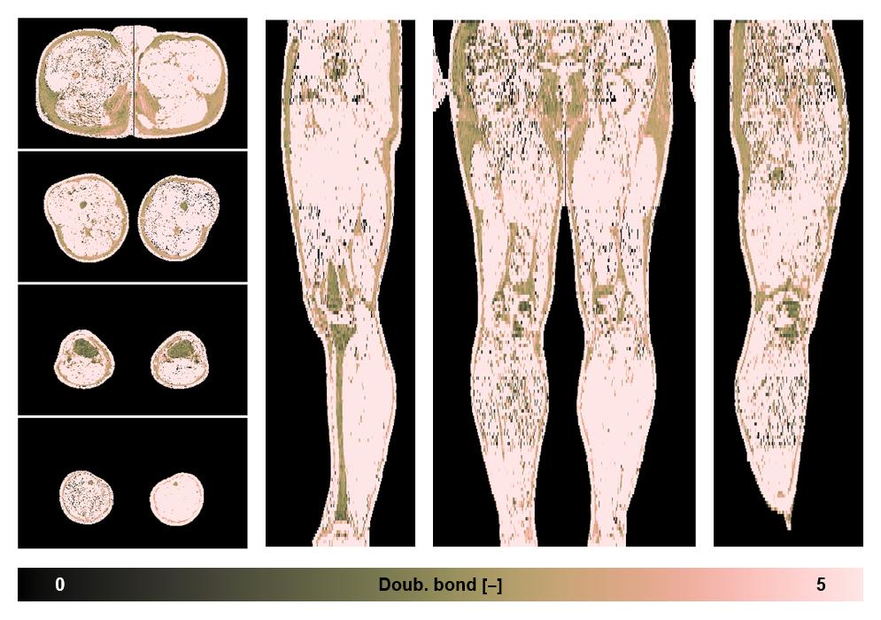 Number of double bonds in subcutanious fat.