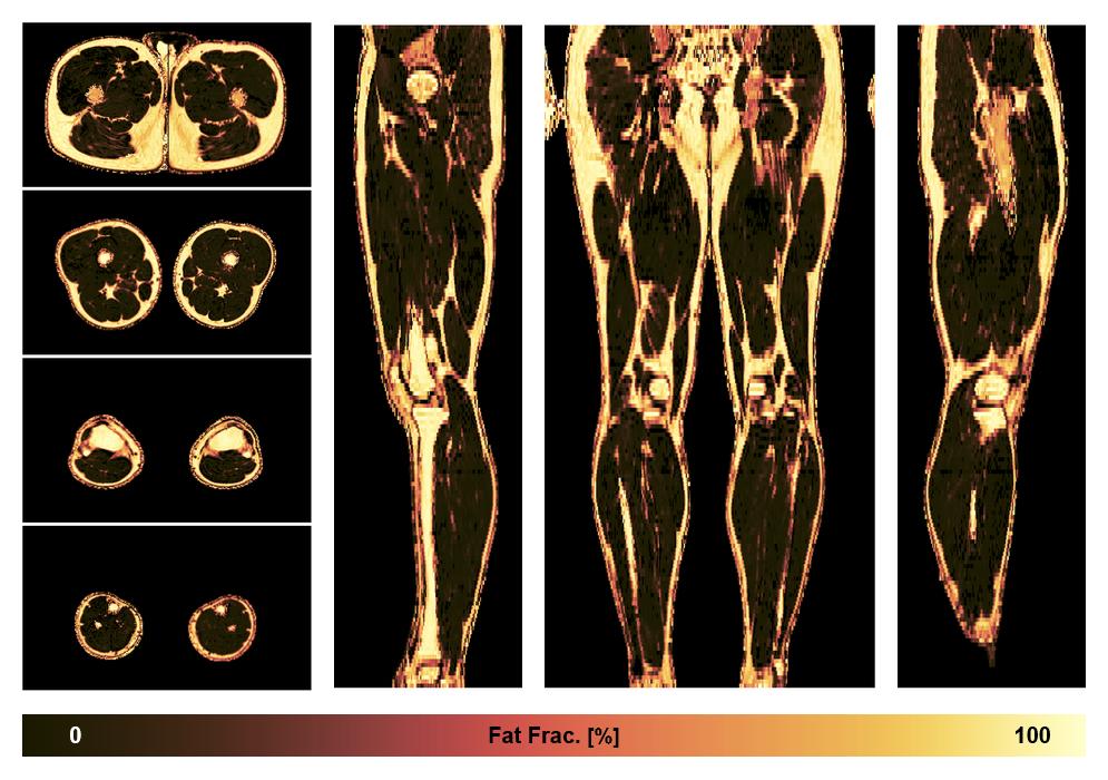 The fat fraction of the lower extremity obtained from the dixon reconstruction for muscle water fat quantification.