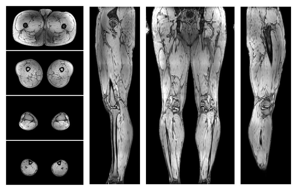 The out-phase image of the dixon reconstruction for water fat quantification.