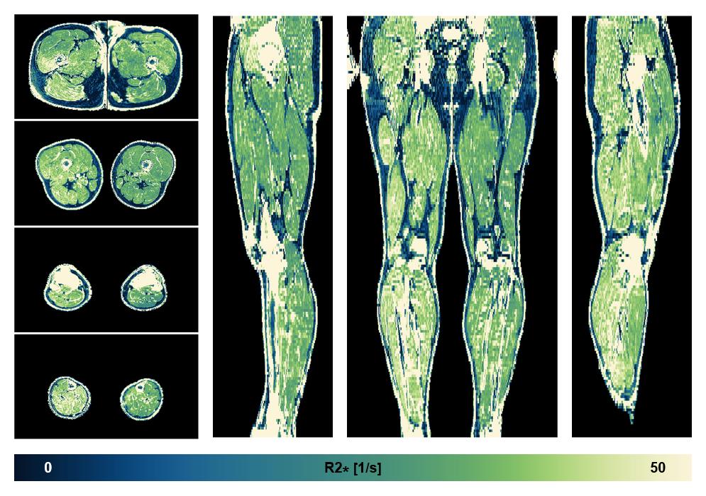 The R2 star relaxation time of the lower extremity obtained from the dixon reconstruction for muscle water fat quantification.