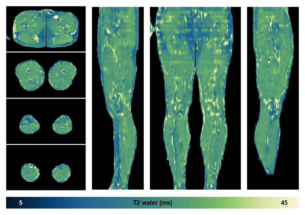 The water only T2 relaxation time of the lower extremity obtained from multi echo spin echo t2 mapping with EPG based reconstruction.
