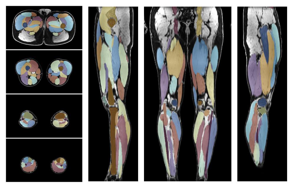 Overlay of automated muscle segmentation labels on dixon water image.