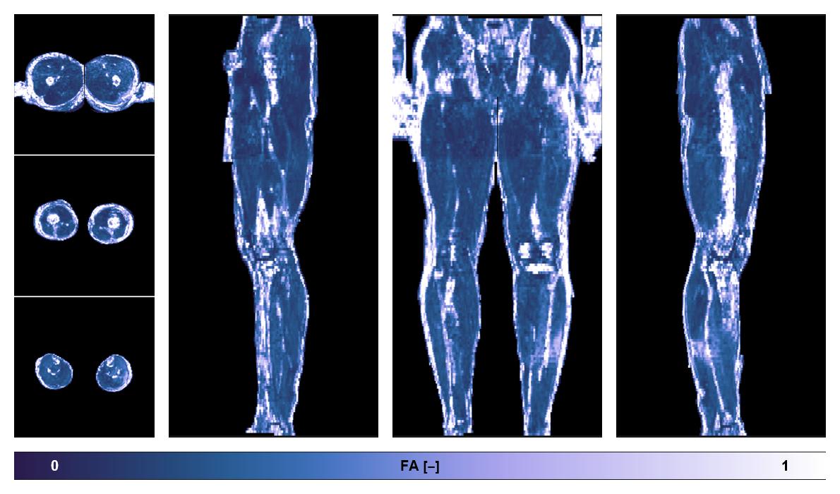IVIM corrected whole leg muscle fractional anisotropy obtained from diffusion tensor imaging.