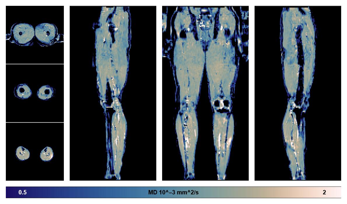 IVIM corrected whole leg muscle mean diffusivity obtained from diffusion tensor imaging.