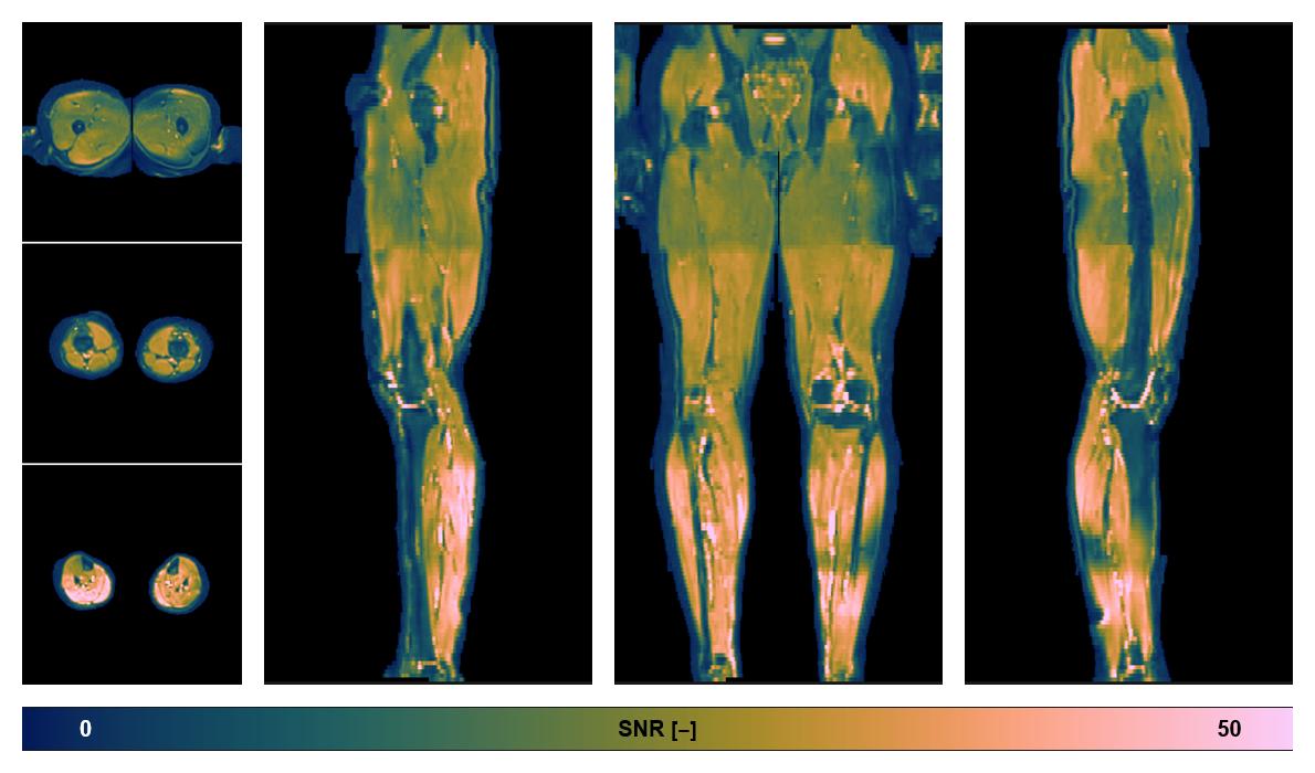 SNR distribution of the unweighted diffusion data.