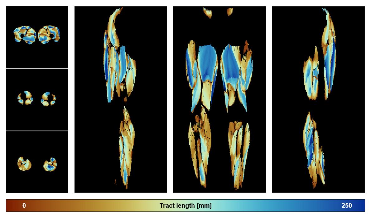 Muscle fiber tract length map based on whole leg DTI based fiber tractography.