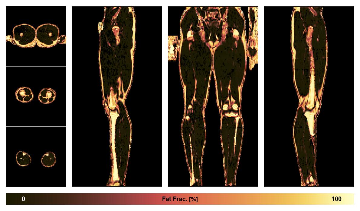 The fat fraction of the lower extremity obtained from the dixon reconstruction for muscle water fat quantification.
